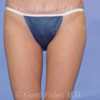 Body Contouring Solutions After, Female 35 - 4312