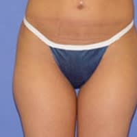 Body Contouring Solutions Before, Female 36 - 4310