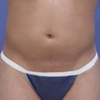 Body Contouring Solutions Before, Female 37 - 4313