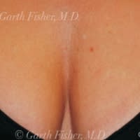 Laser Skin Resurfacing After, Female 37 - 4317