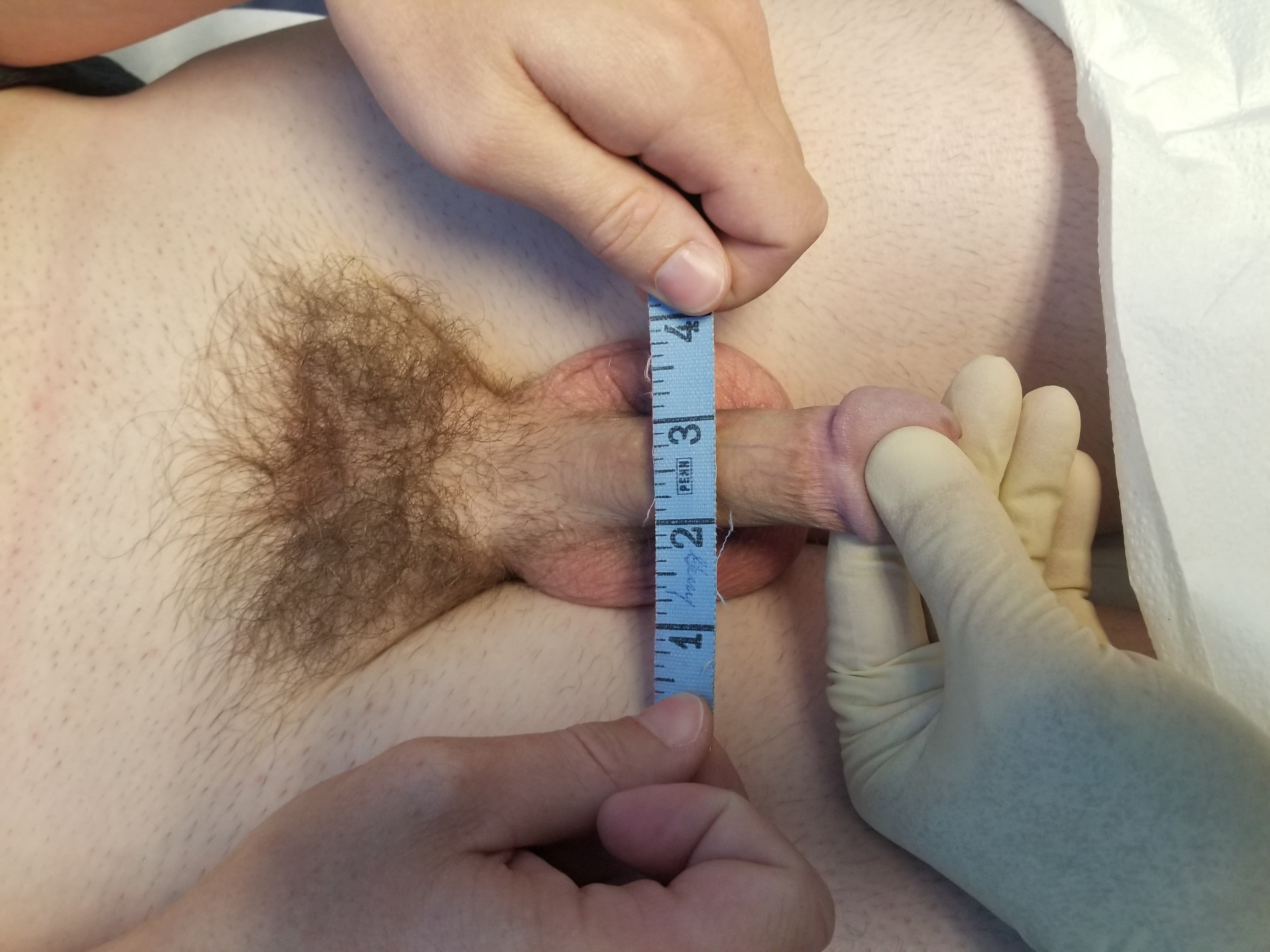 Penis Enlargement Before, Male 32 - 509
