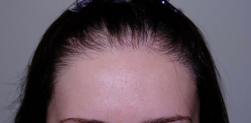 Forehead Reduction (Hair Lowering) After, Female 23 - 2251