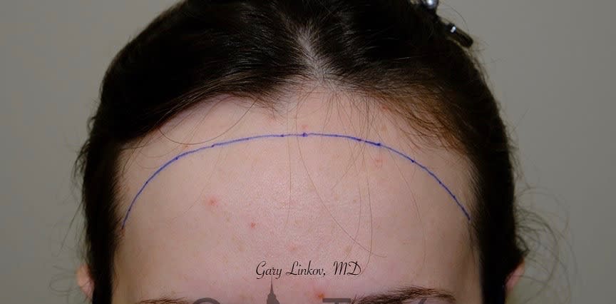 Forehead Reduction (Hair Lowering) Before, Female 23 - 2251