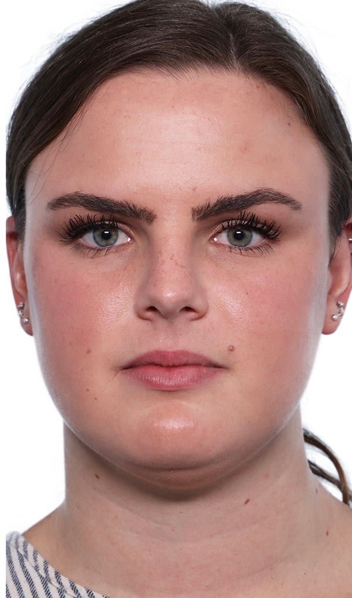 Buccal Fat Removal (Cheek Reduction) Before, Female 34 - 2313