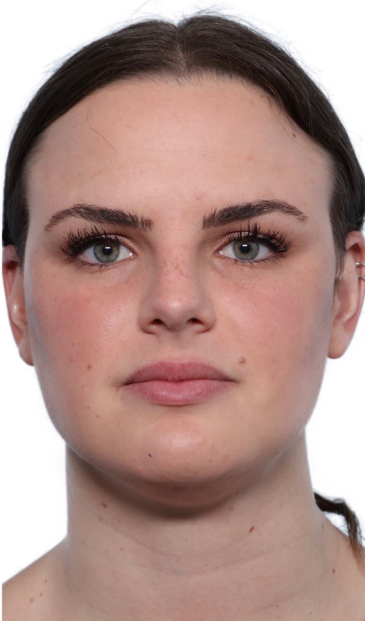 Buccal Fat Removal (Cheek Reduction) After, Female 34 - 2313
