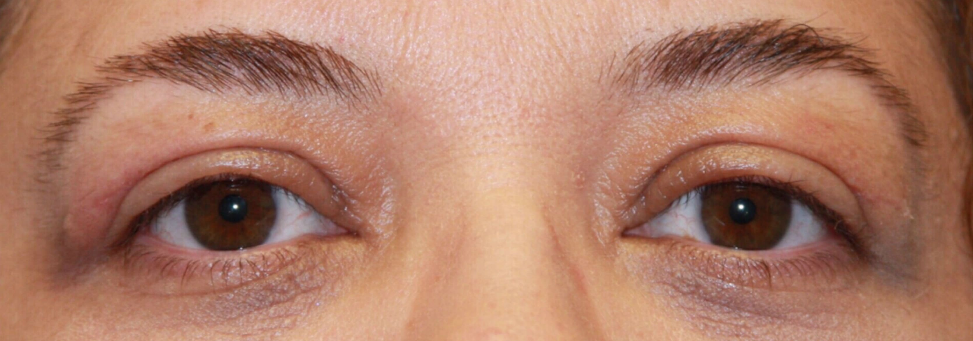 Blepharoplasty After, Female 45 - 111