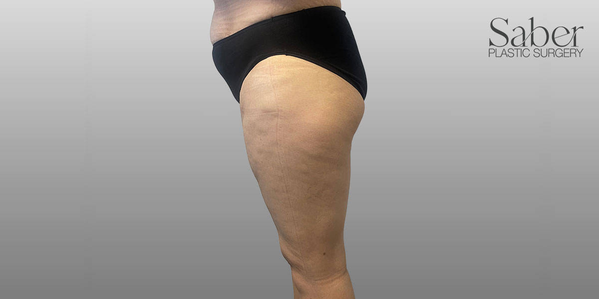Thigh Lift Before, Female 43 - 3950
