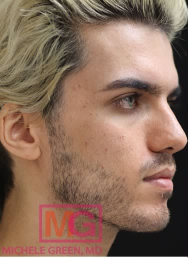 Acne Scar Treatment Before, Male 24 - 1095