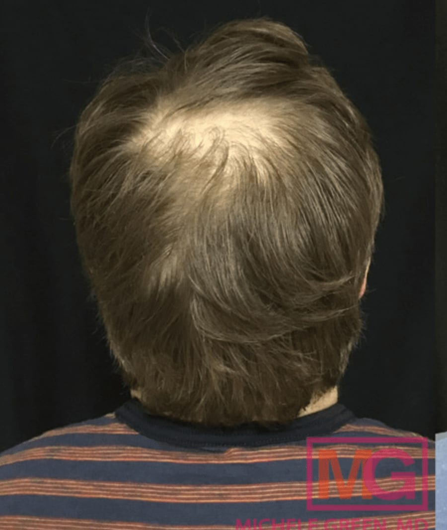 Platelet-Rich Plasma (PRP) Injections for Hair Loss Before, Male 39 - 1112