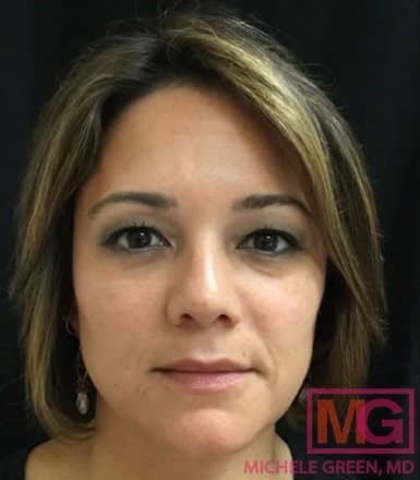 Dermal Fillers & Injectables Before, Female 30 - 1105