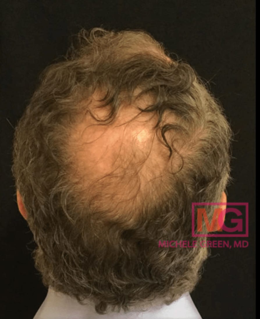 Platelet-Rich Plasma (PRP) Injections for Hair Loss Before, Male 48 - 1110