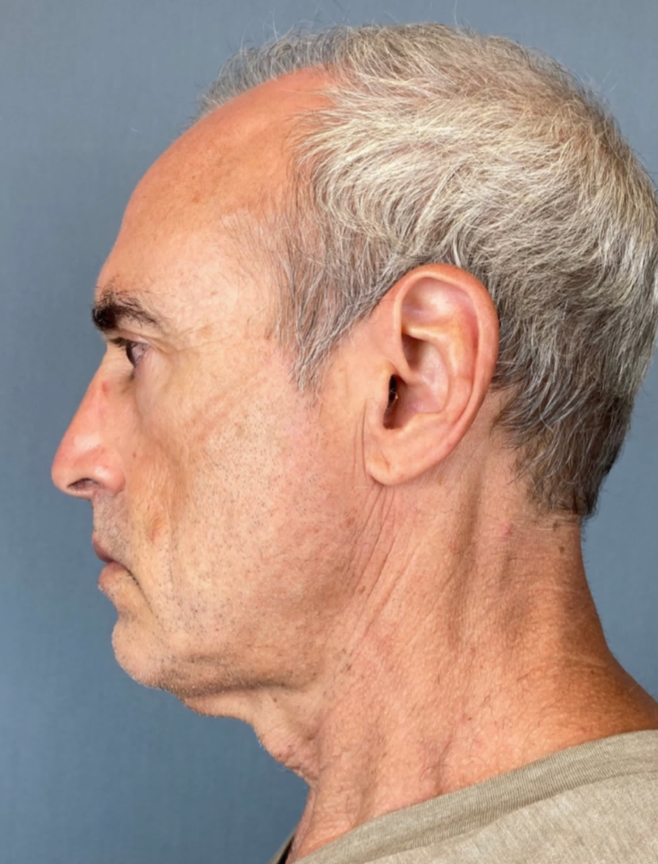 Neck Lift Before, Male 53 - 1302