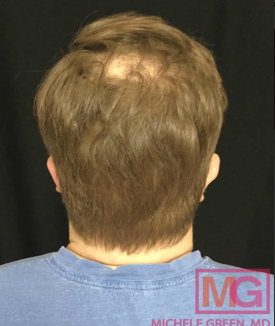 Platelet-Rich Plasma (PRP) Injections for Hair Loss After, Male 39 - 1112