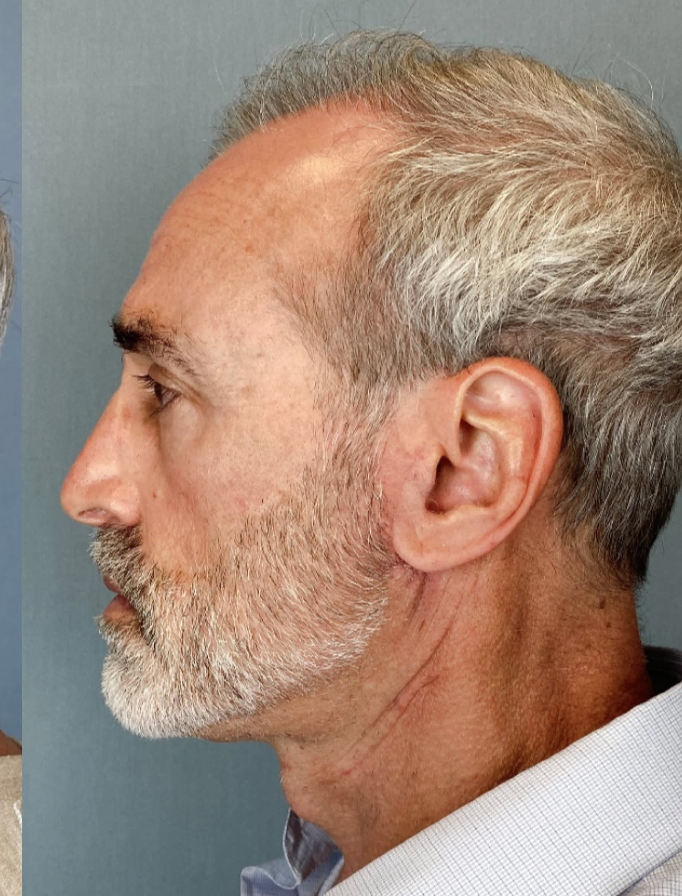 Neck Lift After, Male 53 - 1302