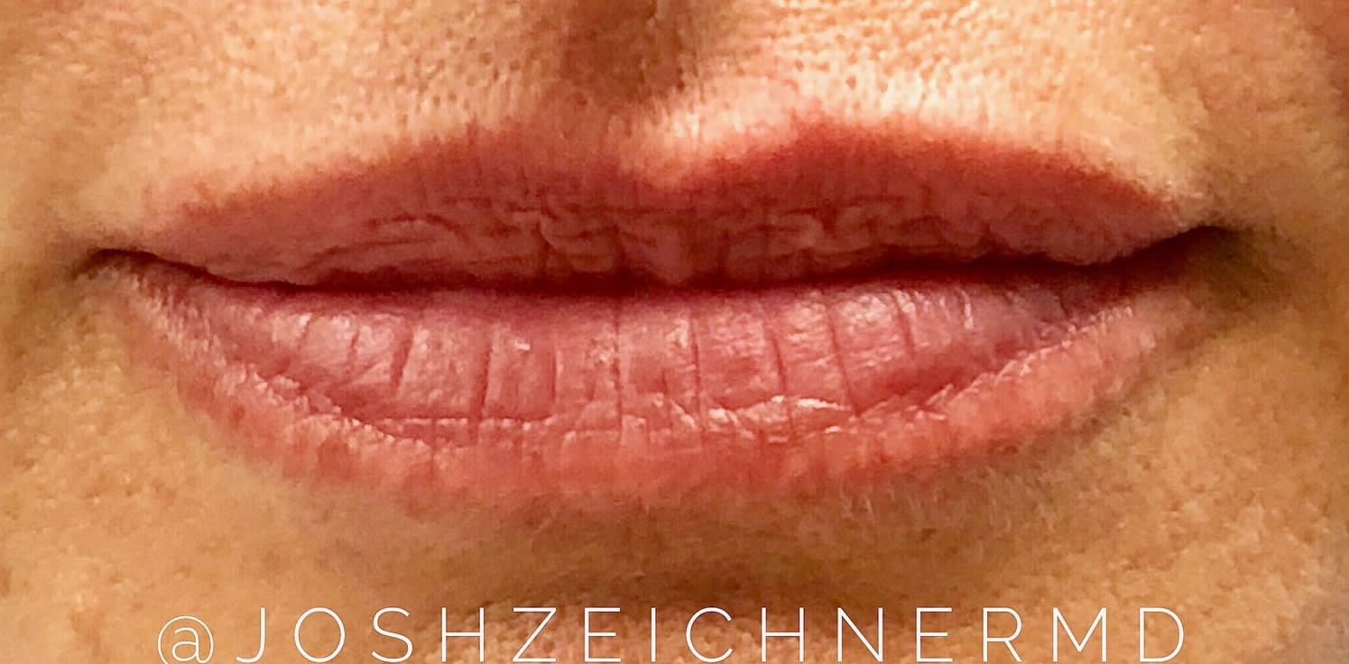 Lip Augmentation and Injections Before, Female 35 - 4861