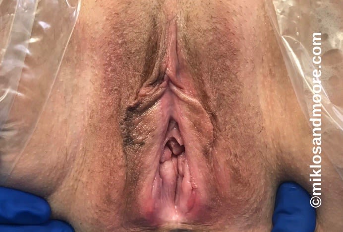 Vaginal Rejuvenation Solutions Before, Female 43 - 2002