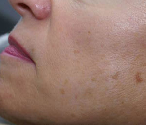 Laser Skin Resurfacing Before, Female 46 - 2082