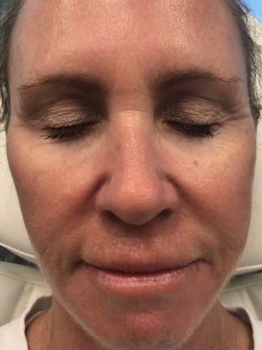 Juvéderm® After, Female 54 - 2324