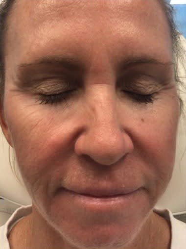 Juvéderm® Before, Female 54 - 2324