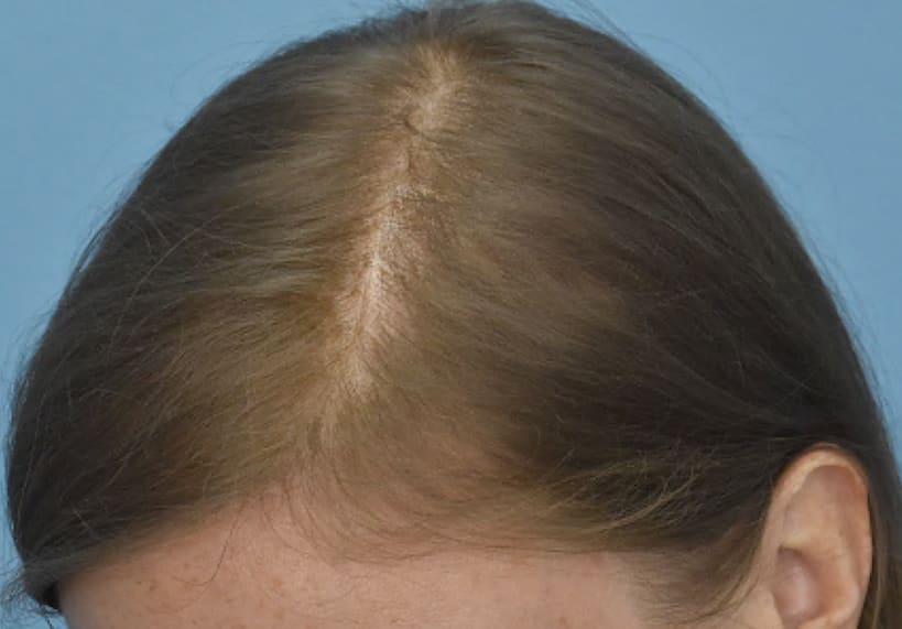 Nanofat & PRP Injections for Hair Loss After, Female 36 - 187