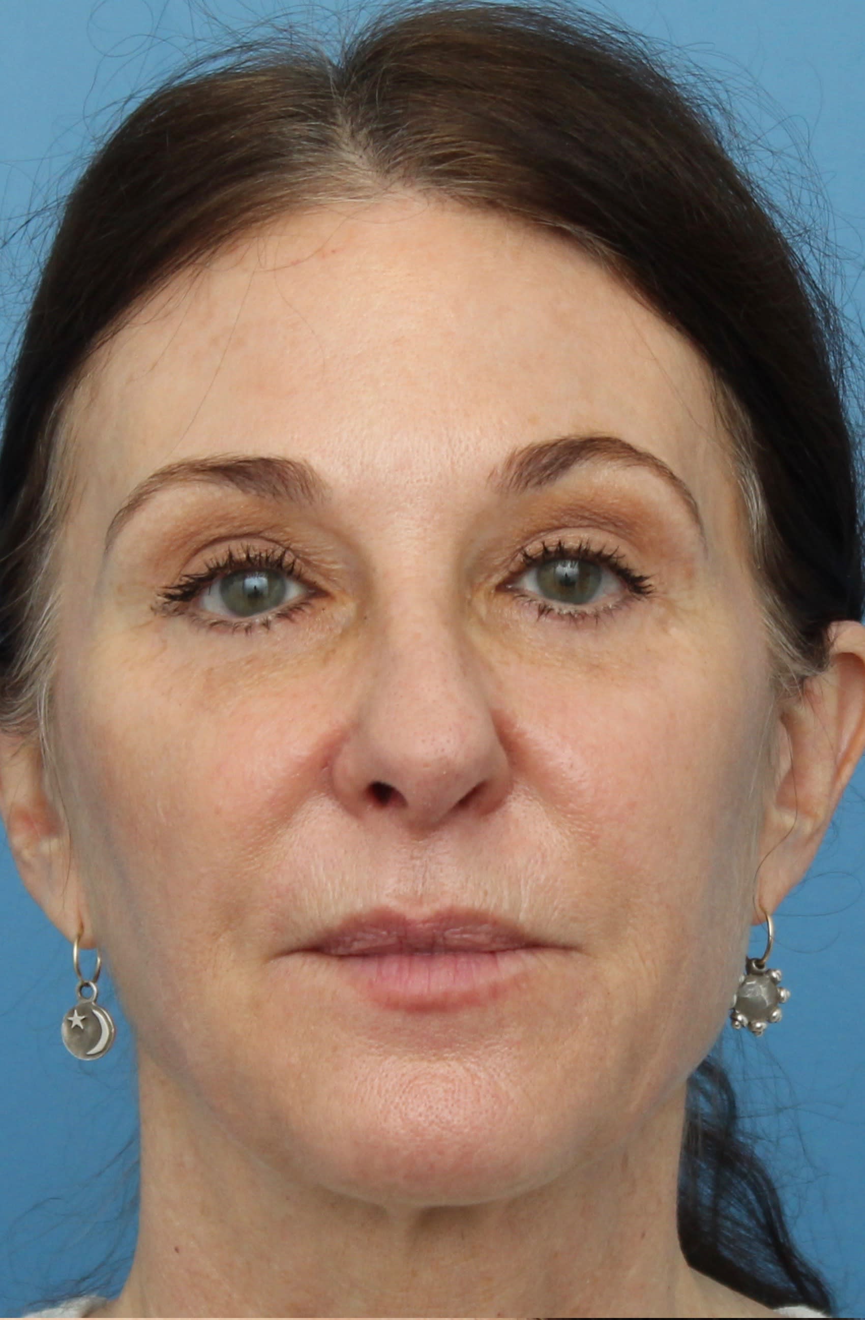 Brow Lift After, Female 62 - 1394