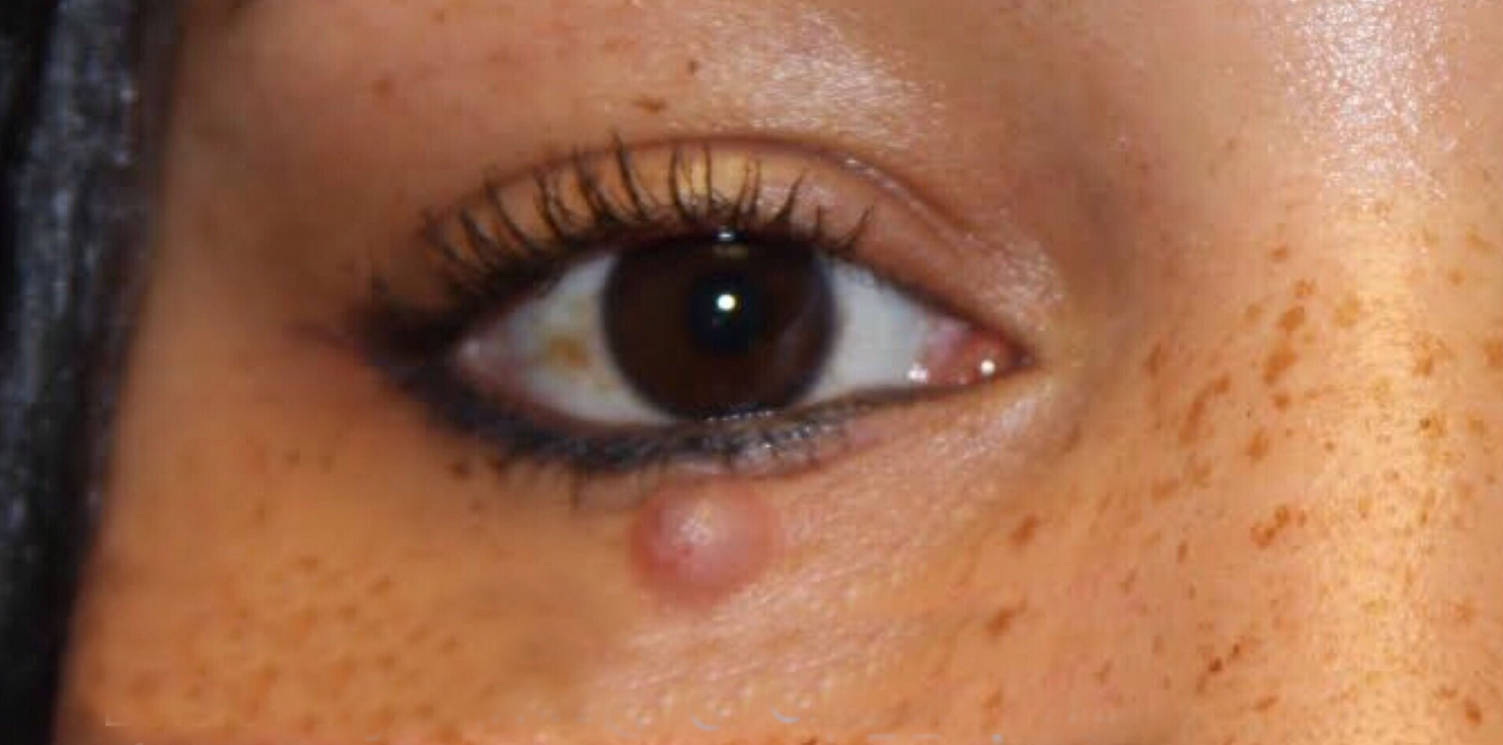 Blepharoplasty Before, Female 25 - 108