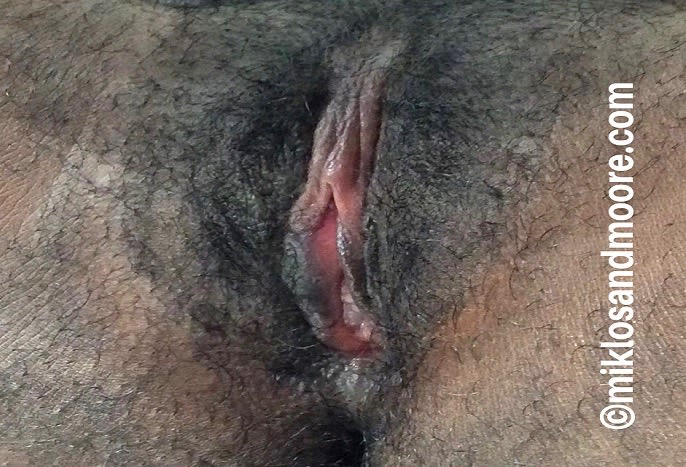 Clitoral Hood Reduction After, Female 42 - 1869