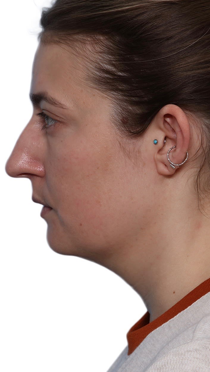 Buccal Fat Removal Before, Female 35 - 2314