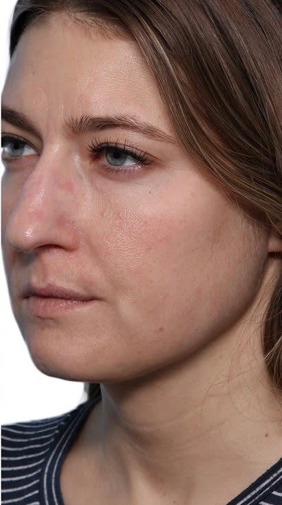 Buccal Fat Removal After, Female 35 - 2315