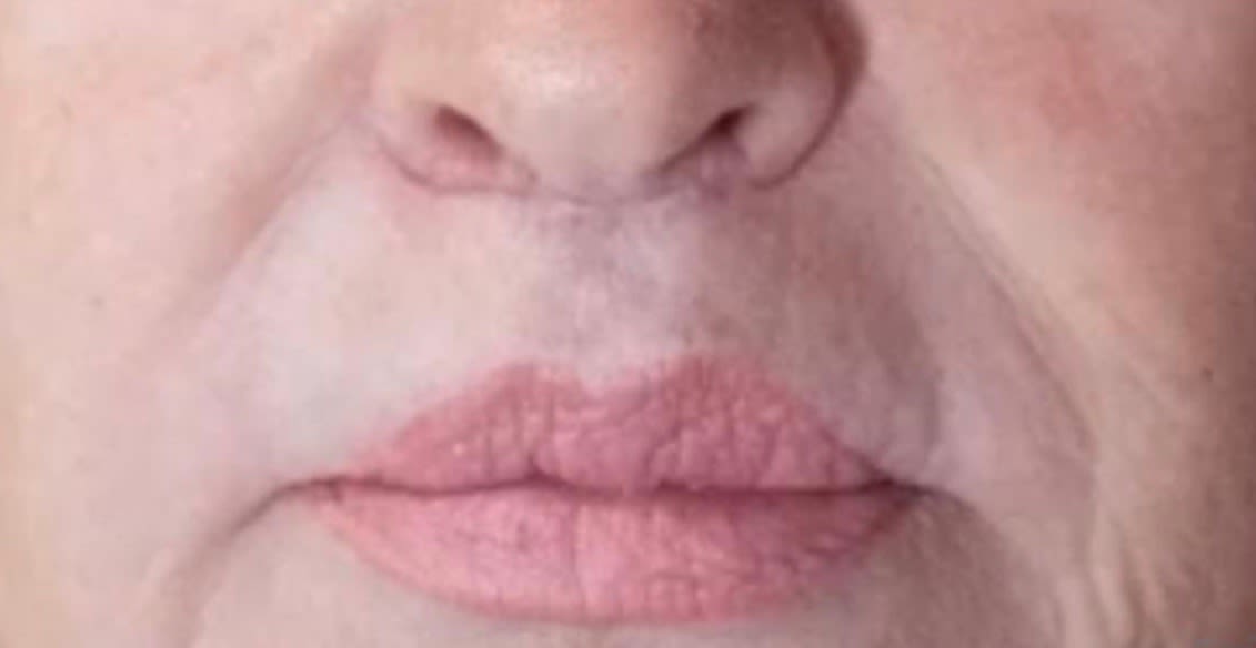 Subnasal 'Bullhorn' Lip Lift After, Female 60 - 2368