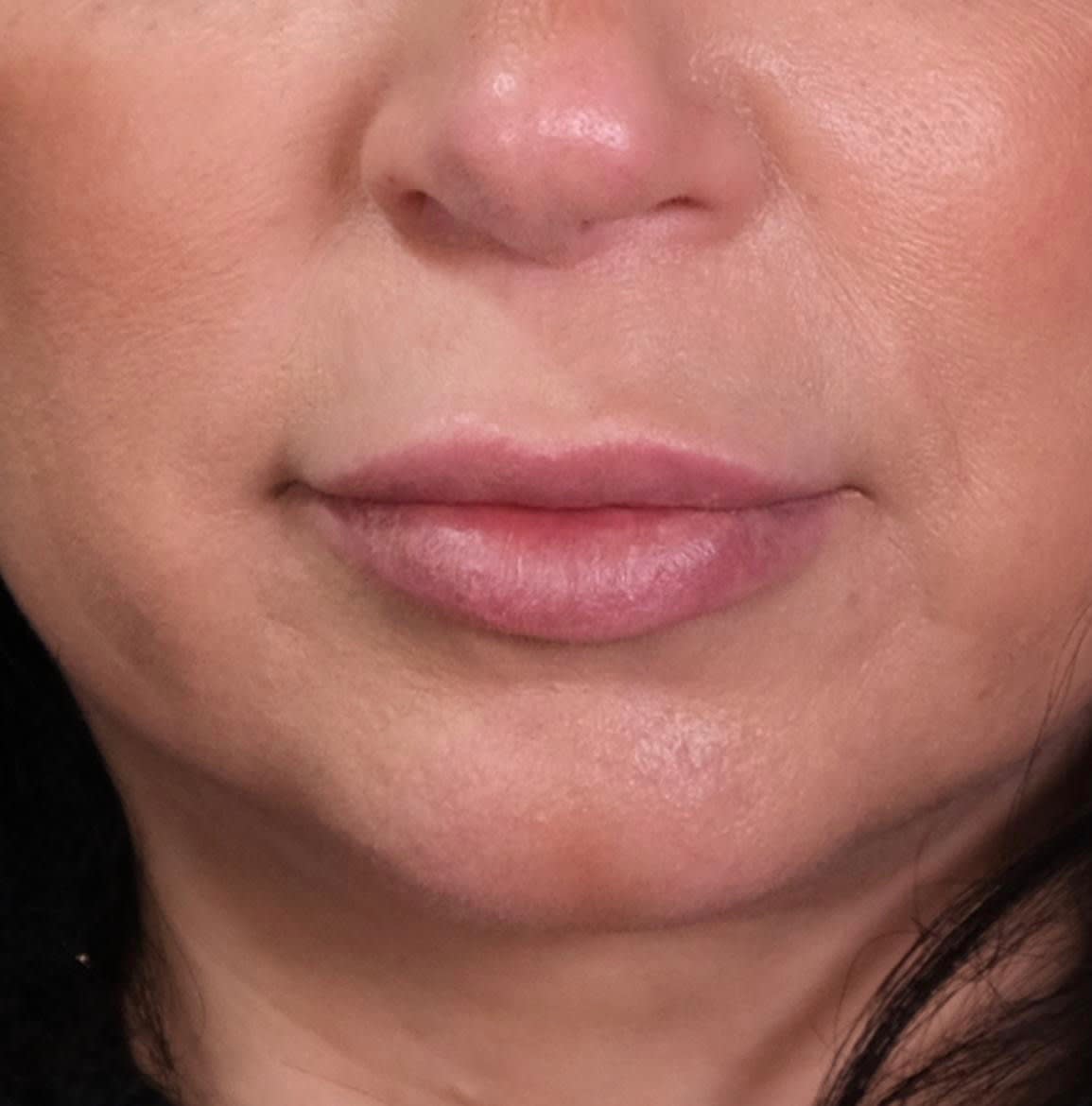 Subnasal 'Bullhorn' Lip Lift Before, Female 42 - 2369