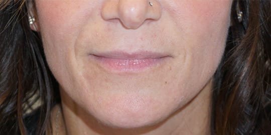 Dermal Fillers & Injectables Before, Female 48 - 2634