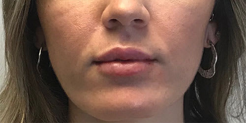 Dermal Fillers & Injectables After, Female 28 - 2629