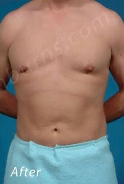 Liposuction After, Male 41 - 2206