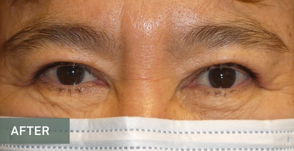 Upper Eyelid Blepharoplasty After, Female 64 - 4863