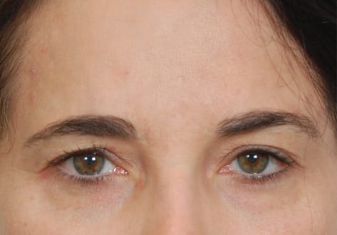 Blepharoplasty Before, Female 55 - 21
