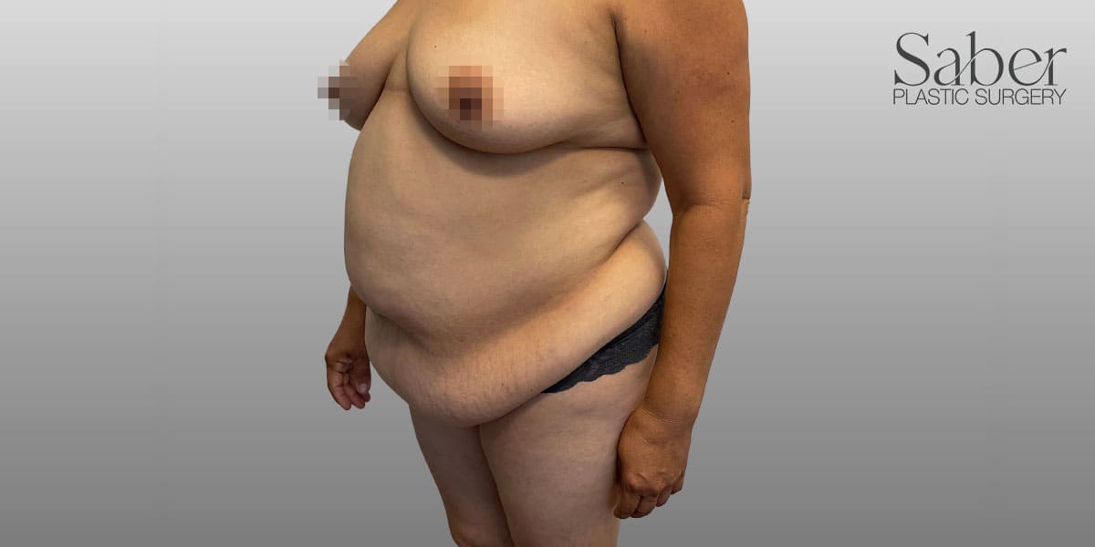 Mommy Makeover Solutions Before, Female 45 - 3942