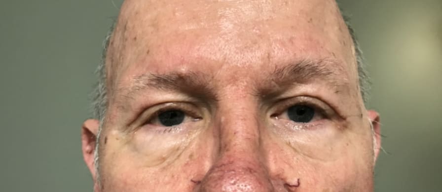 Eyelid Correction Solutions After, Male 56 - 3834
