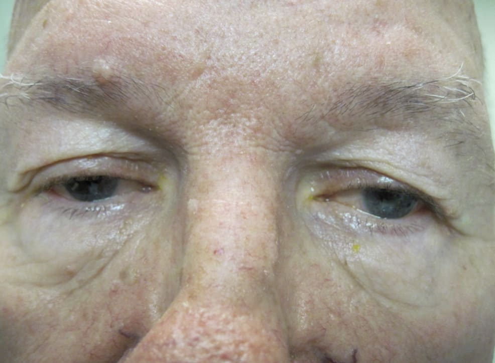 Eyelid Correction Solutions Before, Male 60 - 3833