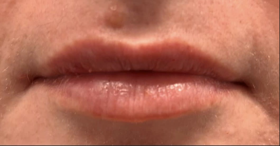 Dermal Fillers & Injectables After, Female 27 - 4132