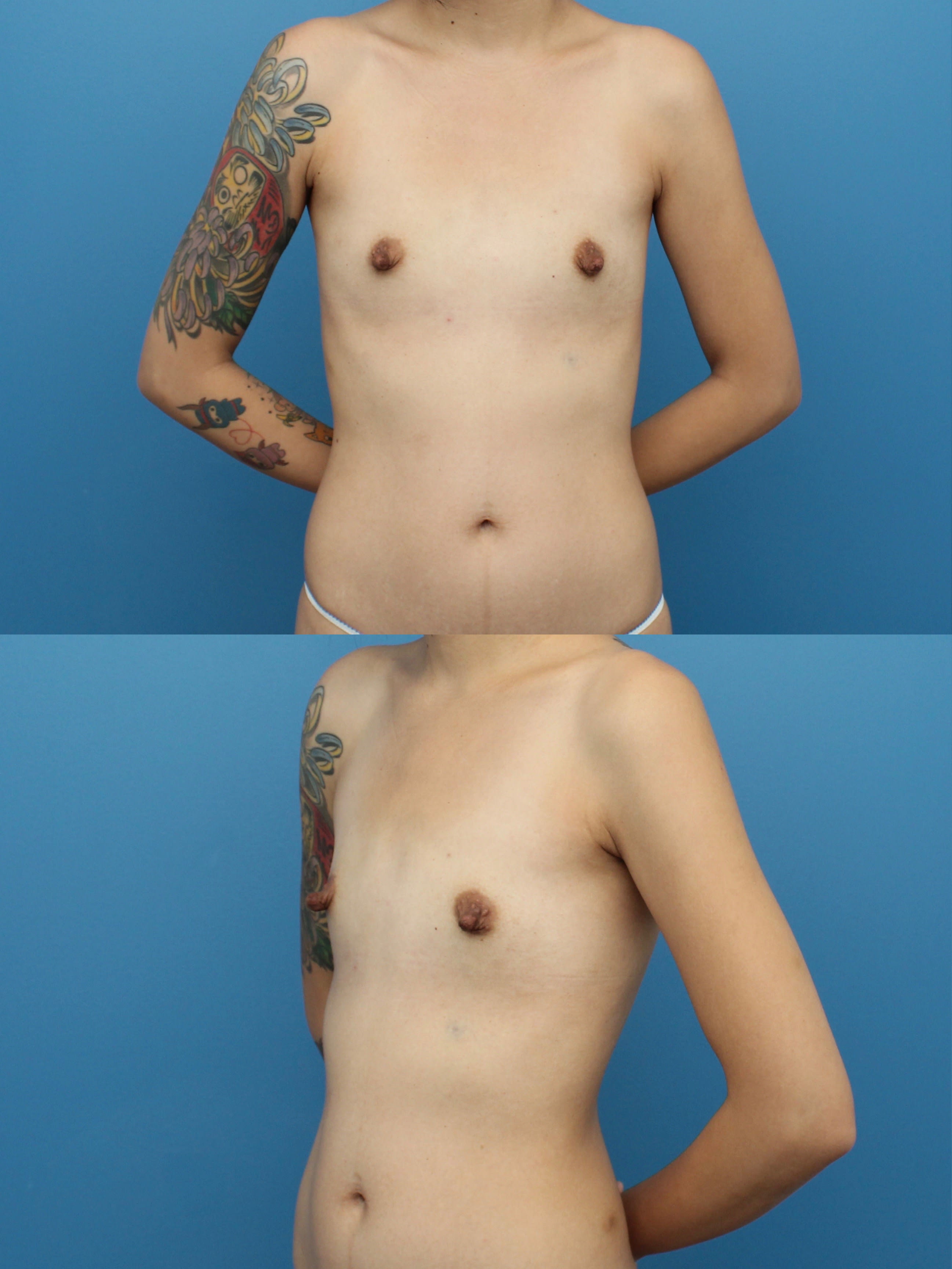Breast Augmentation (Augmentation Mammaplasty) Before, Female 24 - 1402