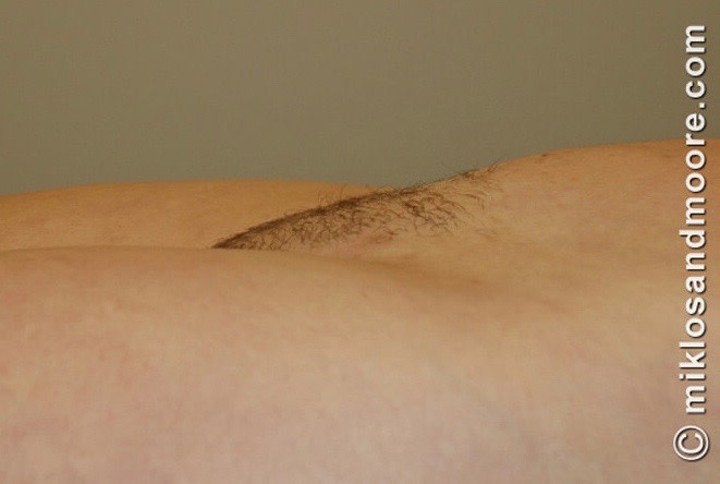 Monsplasty After, Female 42 - 3414