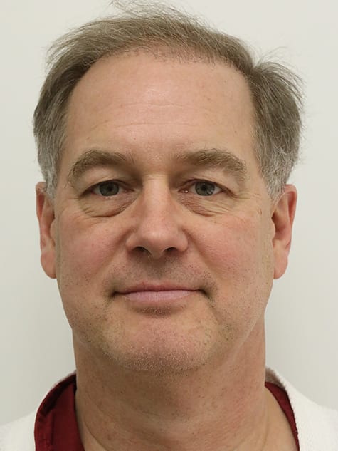 Blepharoplasty Before, Male 57 - 19