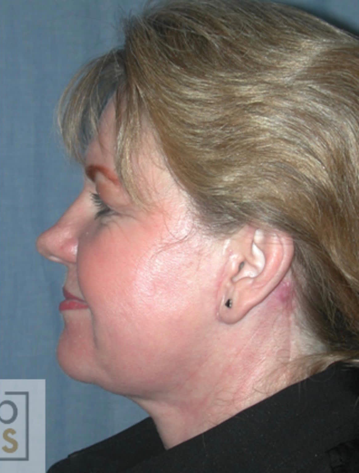 Medium Depth Chemical Peels After, Female 47 - 1967