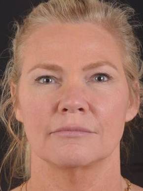 Neck Lift Before, Female 57 - 1945