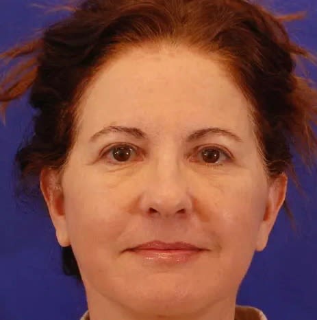 Facelift After, Female 52 - 2821