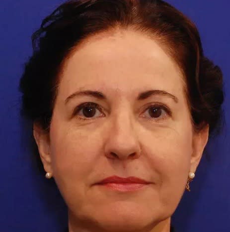 Facelift Before, Female 52 - 2821