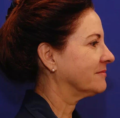 Facelift Before, Female 52 - 2822