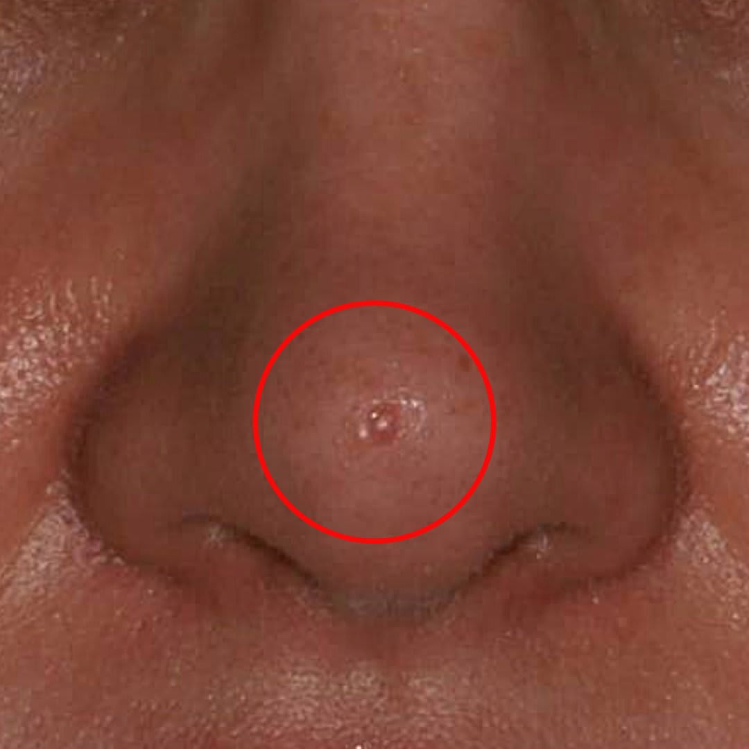 Birthmark, Mole, & Skin Growth Removal Solutions Before, Female 34 - 4860