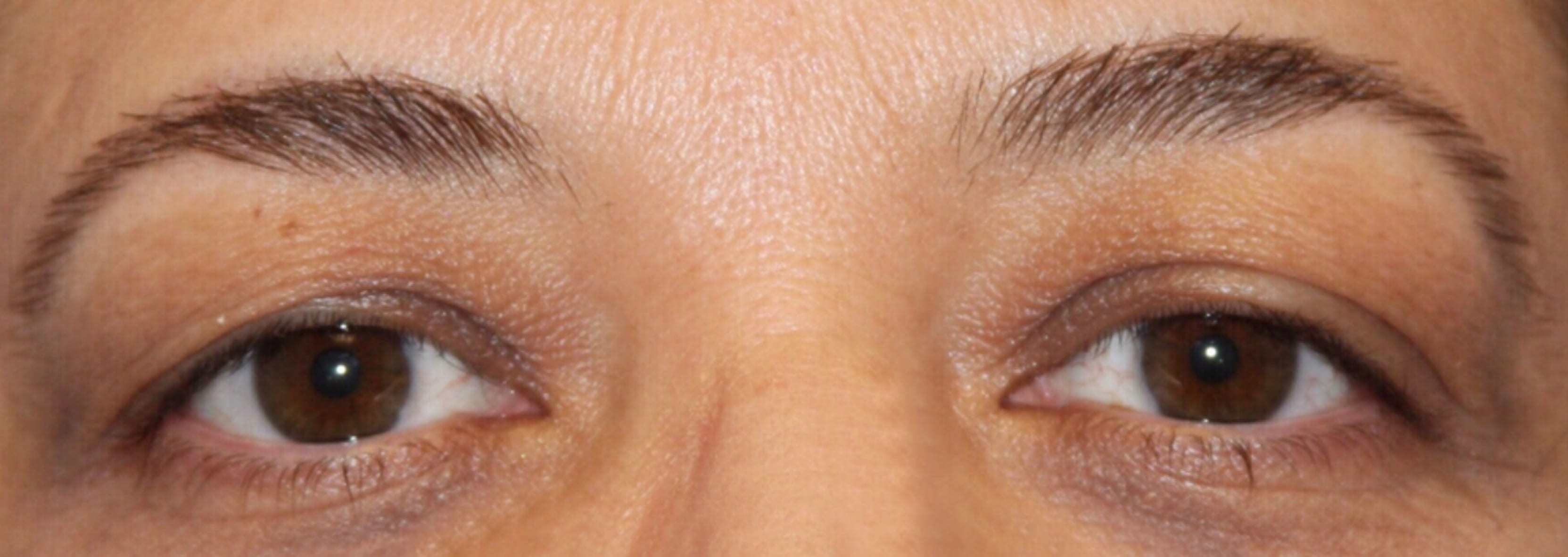 Blepharoplasty Before, Female 45 - 111